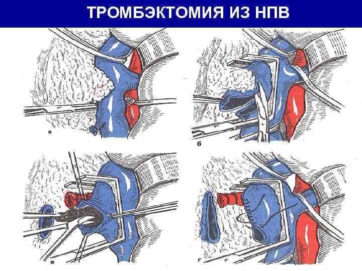 ТРОМБЭКТОМИЯ ИЗ НПВ 