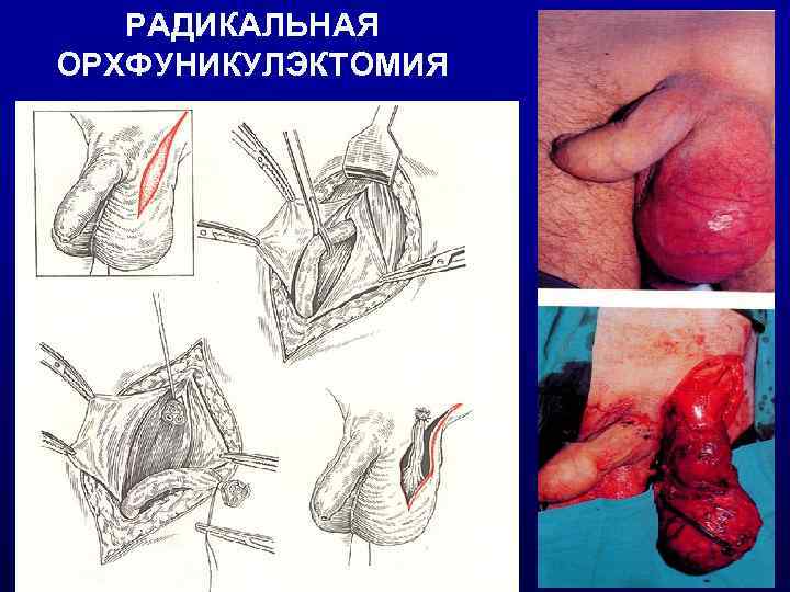 РАДИКАЛЬНАЯ ОРХФУНИКУЛЭКТОМИЯ 