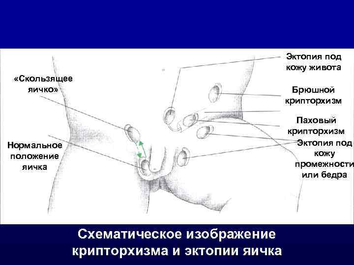 Эктопия под кожу живота «Скользящее яичко» Нормальное положение яичка Схематическое изображение крипторхизма и эктопии