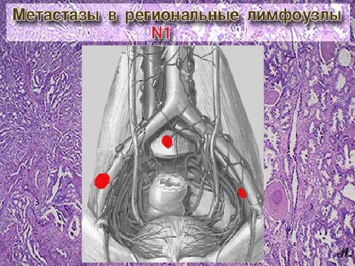 Метастазы в паховые лимфоузлы. Регионарные лимфатические узлы предстательной железы. Метастазы в регионарные лимфатические узлы. Метастазы в регионарные лимфоузлы. Регионарные лимфатические узлы легкого.