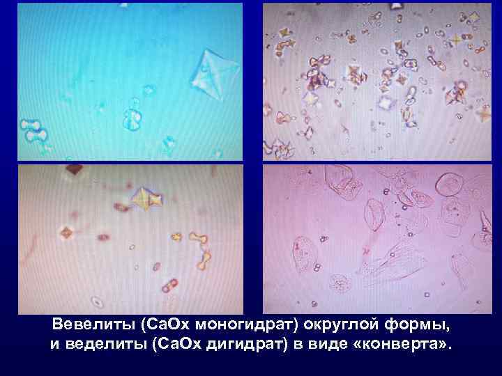 Вевелиты (Ca. Ox моногидрат) округлой формы, и веделиты (Ca. Ox дигидрат) в виде «конверта»