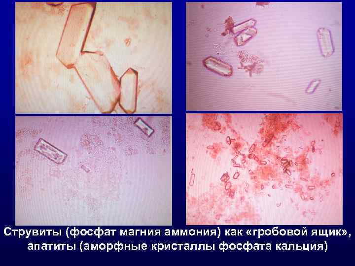 Струвиты (фосфат магния аммония) как «гробовой ящик» , апатиты (аморфные кристаллы фосфата кальция) 