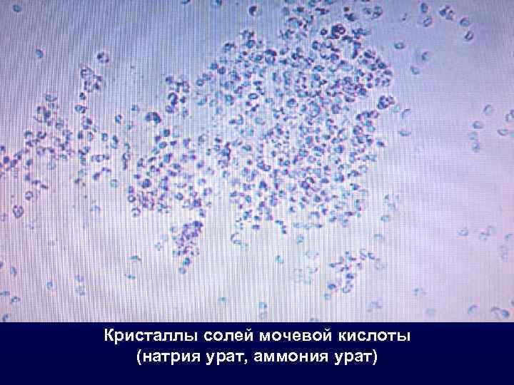 Кристаллы солей мочевой кислоты (натрия урат, аммония урат) 