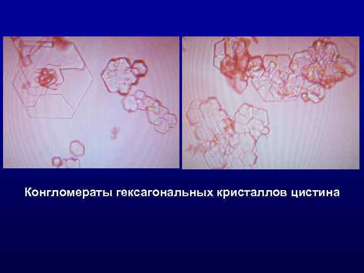 Конгломераты гексагональных кристаллов цистина 