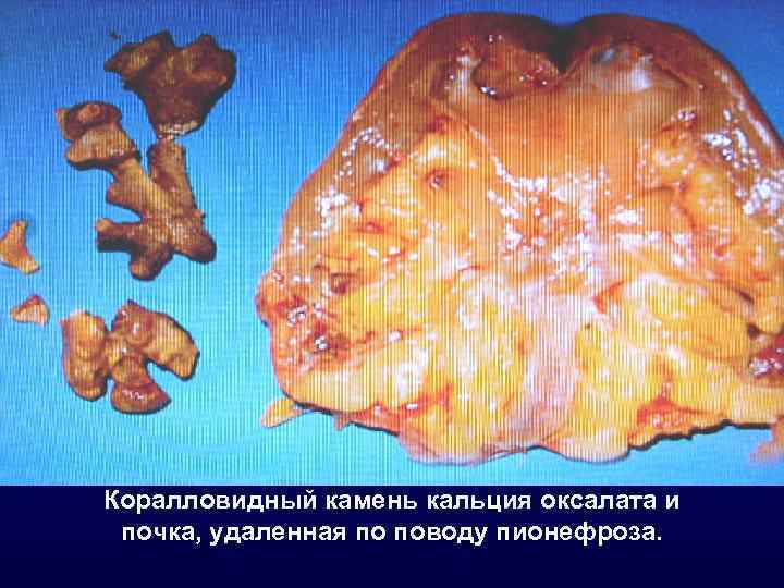 Коралловидный камень кальция оксалата и почка, удаленная по поводу пионефроза. 