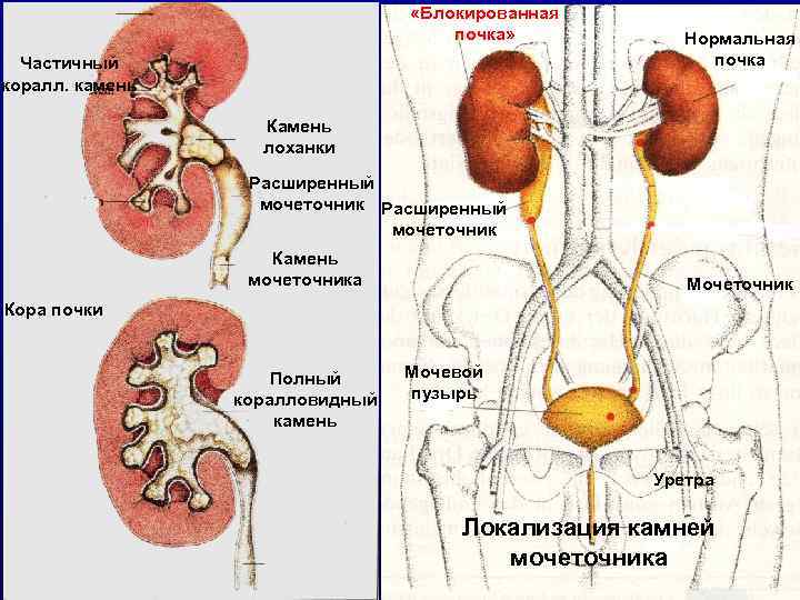  «Блокированная почка» Частичный коралл. камень Нормальная почка Камень лоханки Расширенный мочеточник Камень мочеточника