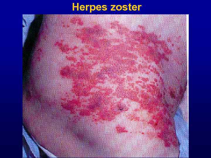 Herpes zoster 