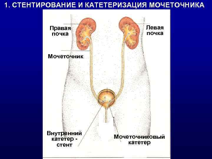 1. СТЕНТИРОВАНИЕ И КАТЕТЕРИЗАЦИЯ МОЧЕТОЧНИКА Правая почка Левая почка Мочеточник Внутренний катетер стент Мочеточниковый