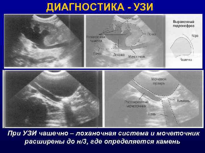 ДИАГНОСТИКА - УЗИ При УЗИ чашечно – лоханочная система и мочеточник расширены до н/3,