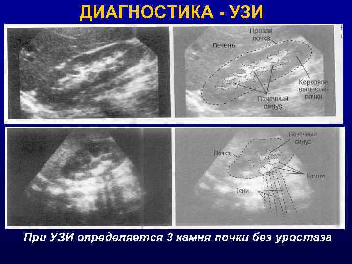 ДИАГНОСТИКА - УЗИ При УЗИ определяется 3 камня почки без уростаза 