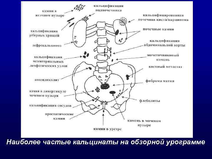 Наиболее частые кальцинаты на обзорной урограмме 