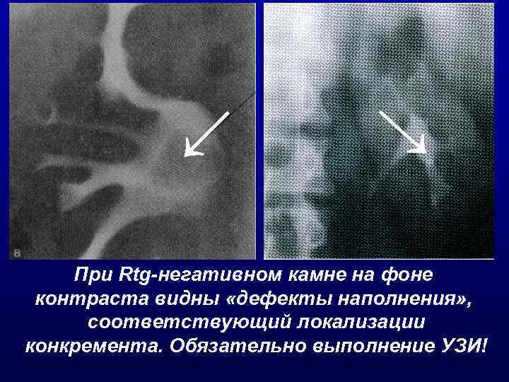 → → При Rtg-негативном камне на фоне контраста видны «дефекты наполнения» , соответствующий локализации