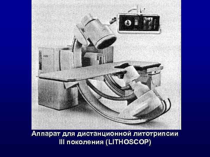 Аппарат для дистанционной литотрипсии III поколения (LITHOSCOP) 