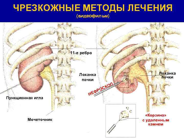 ЧРЕЗКОЖНЫЕ МЕТОДЫ ЛЕЧЕНИЯ (видеофильм) 11 -е ребро Лоханка почки ОП К ОС ФР Пункционная