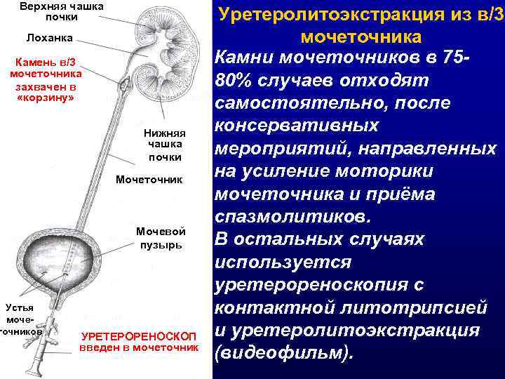 Верхняя чашка почки Лоханка Камень в/3 мочеточника захвачен в «корзину» Устья мочеточников Нижняя чашка