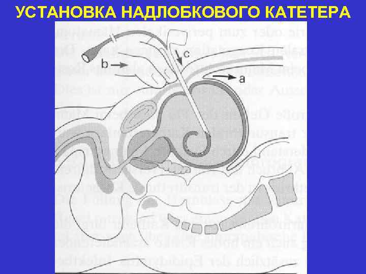 УСТАНОВКА НАДЛОБКОВОГО КАТЕТЕРА 