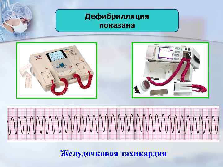 Дефибрилляция показана Желудочковая тахикардия 