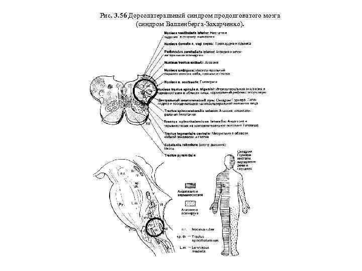 Рис. 3. 56 Дорсолатеральный синдром продолговатого мозга (синдром Валленберга-Захарченко). 