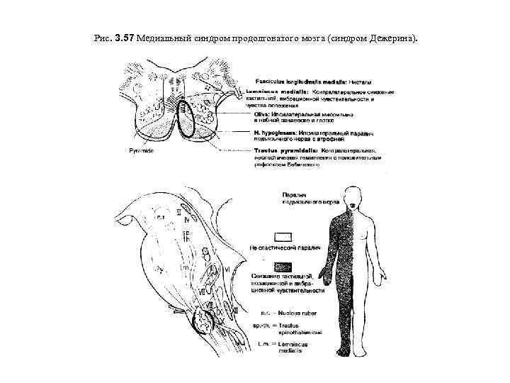 Рис. 3. 57 Медиальный синдром продолговатого мозга (синдром Дежерина). 