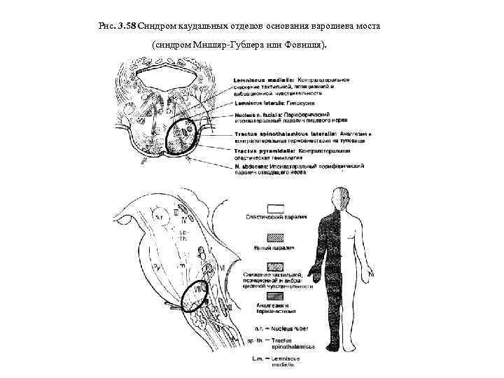 Рис. 3. 58 Синдром каудальных отделов основания варолиева моста (синдром Милляр-Гублера или Фовилля). 