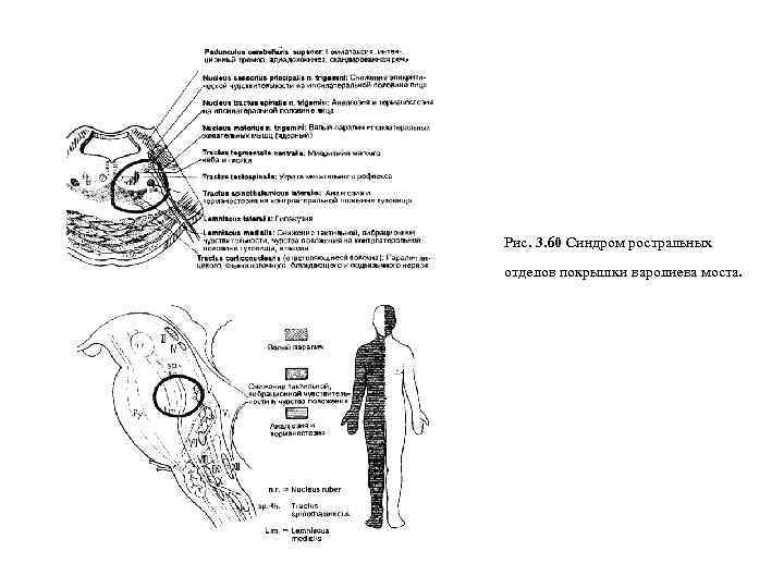 Рис. 3. 60 Синдром ростральных отделов покрышки варолиева моста. 