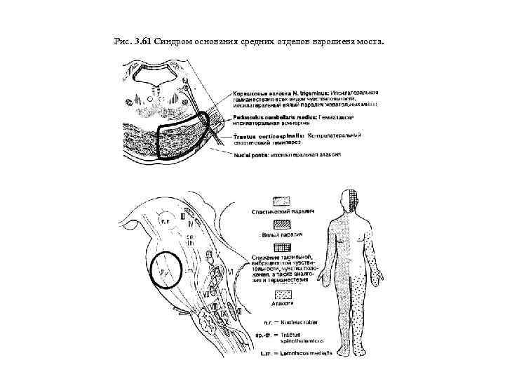 Рис. 3. 61 Синдром основания средних отделов варолиева моста. 