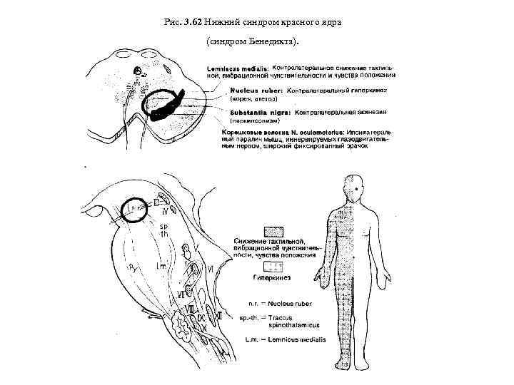 Рис. 3. 62 Нижний синдром красного ядра (синдром Бенедикта). 