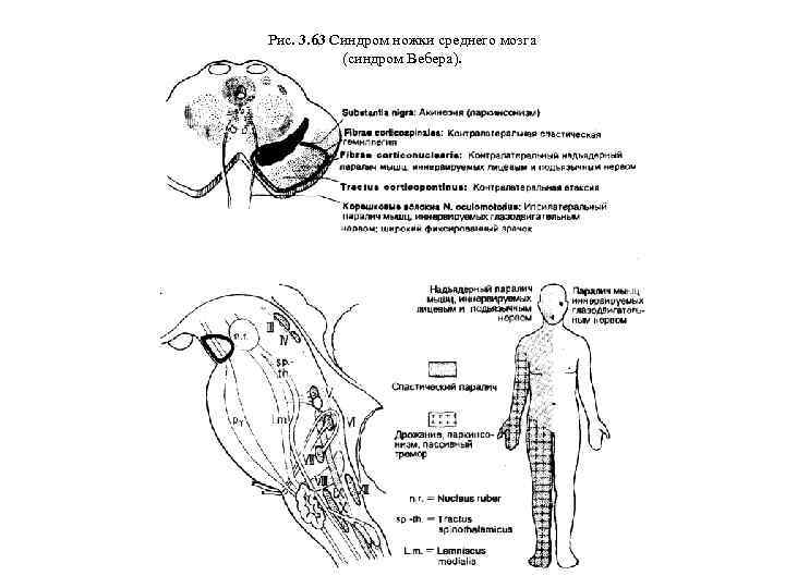 Рис. 3. 63 Синдром ножки среднего мозга (синдром Вебера). 