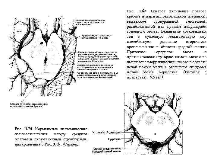 Рис. 3. 69 Тяжелое вклинение правого крючка и парагиппокампальной извилины, вызванное субдуральной гематомой, расположенной