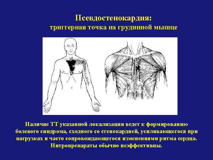 Псевдостенокардия: триггерная точка на грудинной мышце Наличие ТТ указанной локализации ведет к формированию болевого