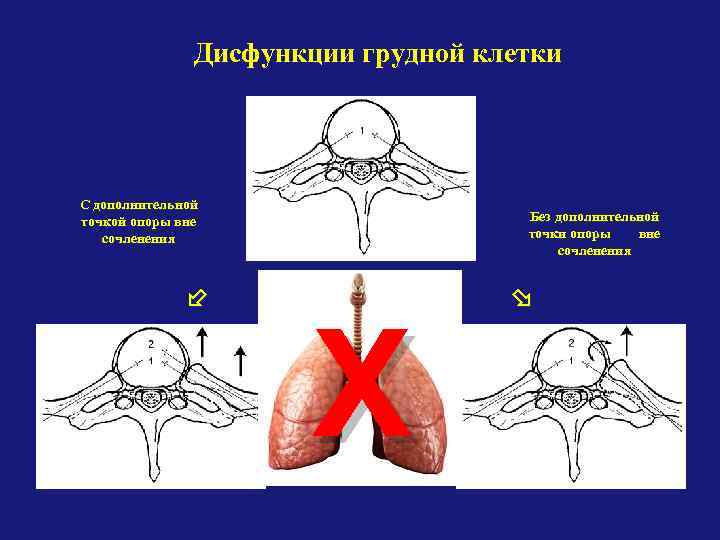 Дисфункции грудной клетки С дополнительной точкой опоры вне сочленения Без дополнительной точки опоры вне