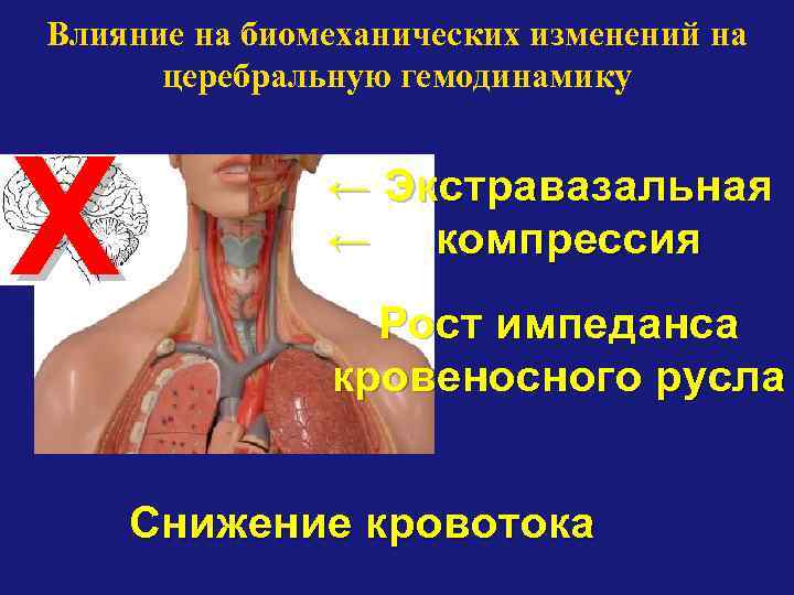 Влияние на биомеханических изменений на церебральную гемодинамику Х ← Экстравазальная ← компрессия Рост импеданса