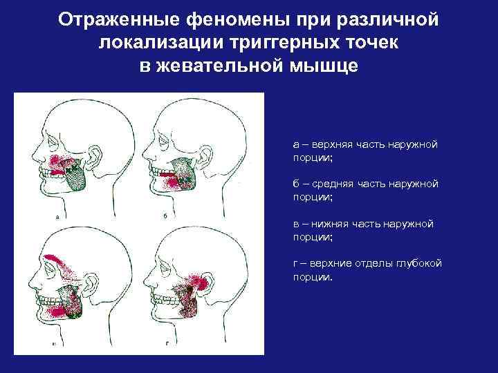 Отраженные феномены при различной локализации триггерных точек в жевательной мышце а – верхняя часть