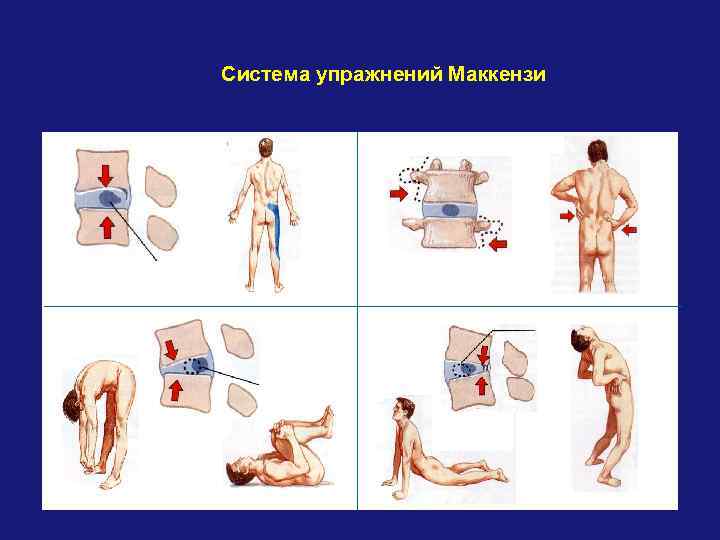 Система упражнений Маккензи 