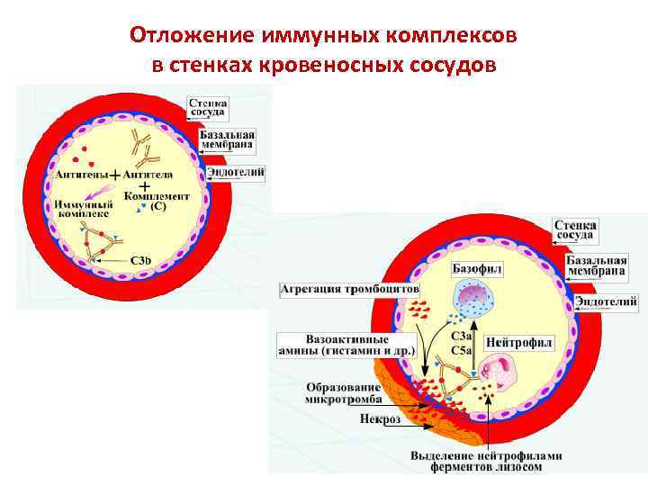 Отложение иммунных комплексов в стенках кровеносных сосудов 