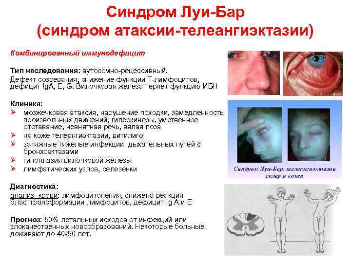 Синдром Луи-Бар (синдром атаксии-телеангиэктазии) Комбинированный иммунодефицит Тип наследования: аутосомно-рецессивный. Дефект созревания, снижение функции Т-лимфоцитов,