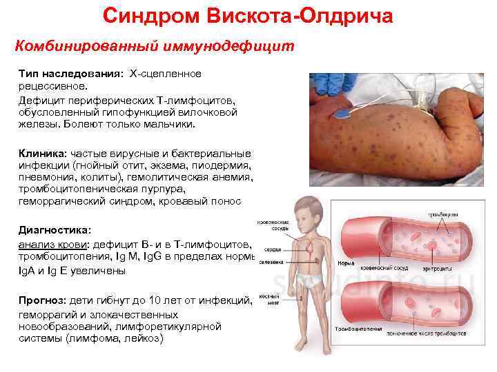 Синдром Вискота-Олдрича Комбинированный иммунодефицит Тип наследования: Х-сцепленное рецессивное. Дефицит периферических Т-лимфоцитов, обусловленный гипофункцией вилочковой