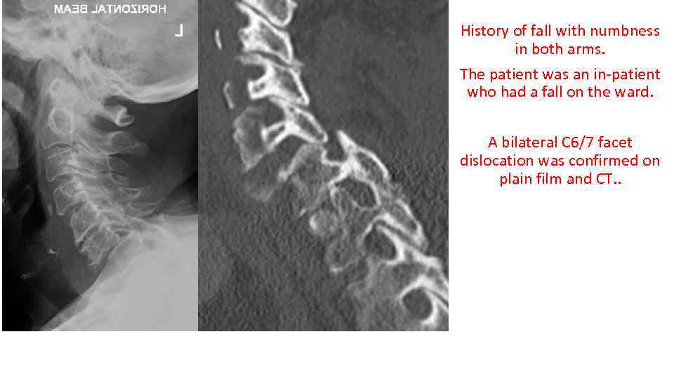 History of fall with numbness in both arms. The patient was an in-patient who