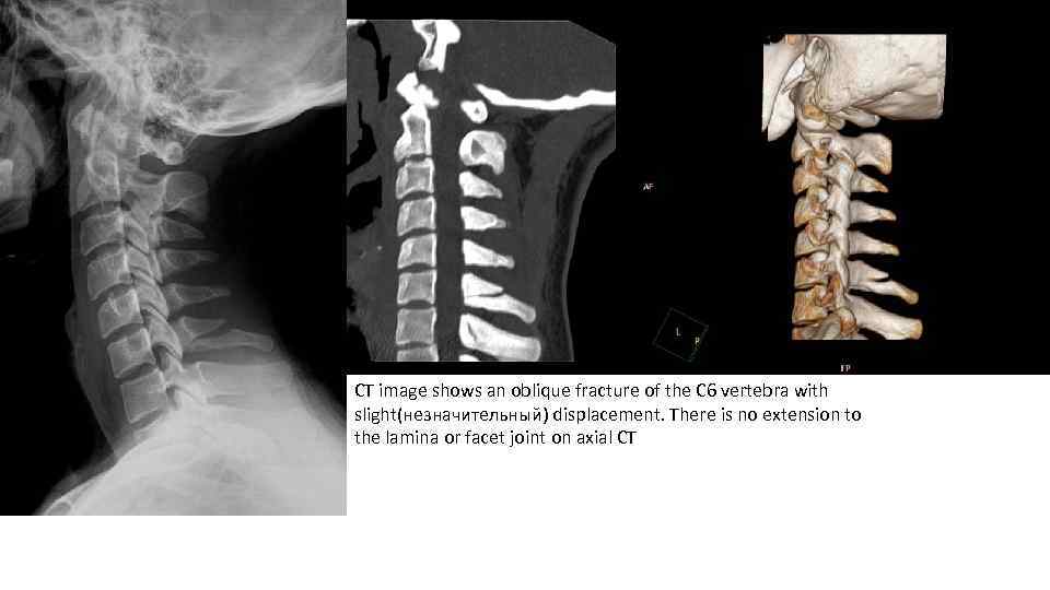 CT image shows an oblique fracture of the C 6 vertebra with slight(незначительный) displacement.