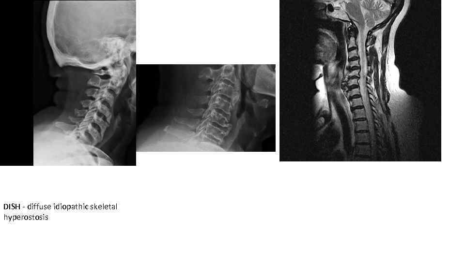 DISH - diffuse idiopathic skeletal hyperostosis 