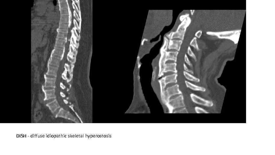 DISH - diffuse idiopathic skeletal hyperostosis 