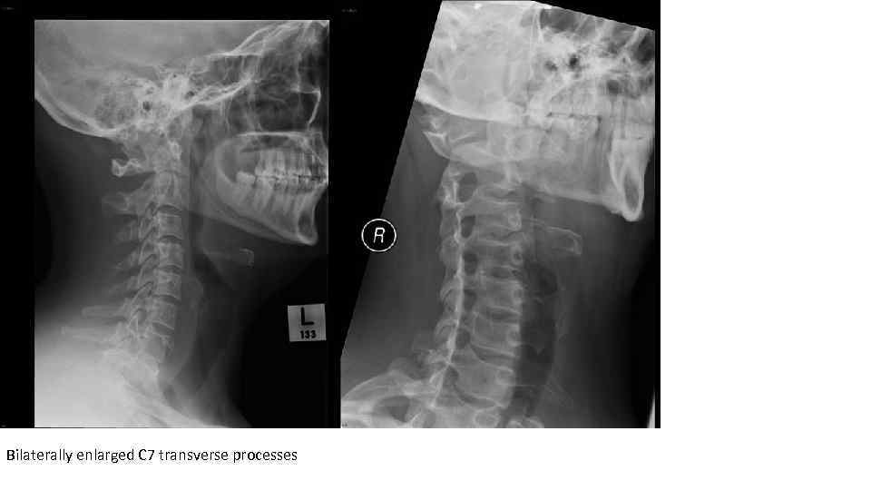 Bilaterally enlarged C 7 transverse processes 