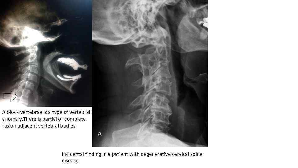 A block vertebrae is a type of vertebral anomaly. There is partial or complete