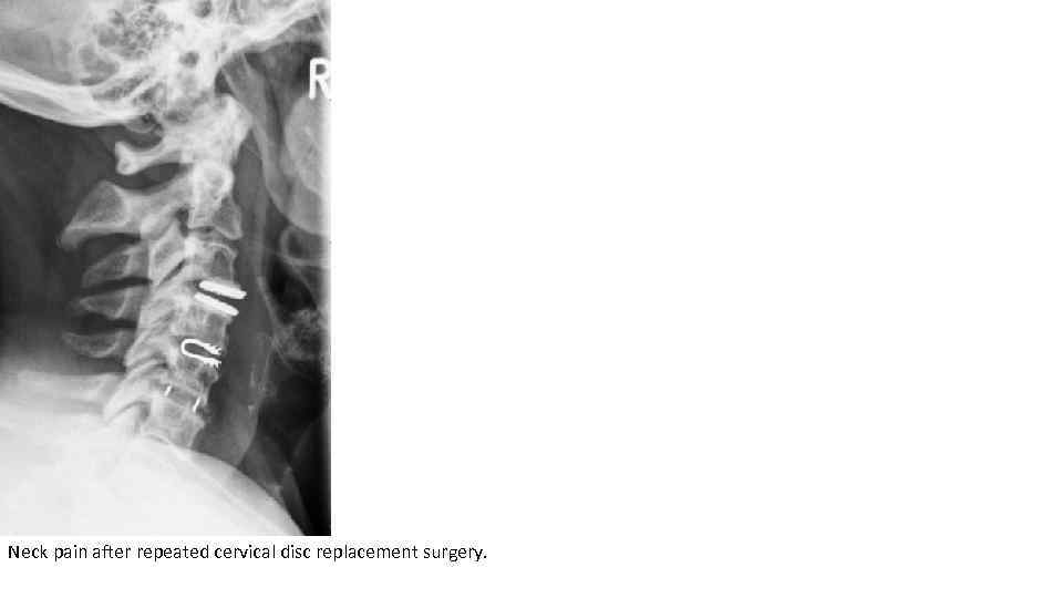 Neck pain after repeated cervical disc replacement surgery. 