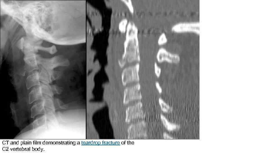 CT and plain film demonstrating a teardrop fracture of the C 2 vertebral body.