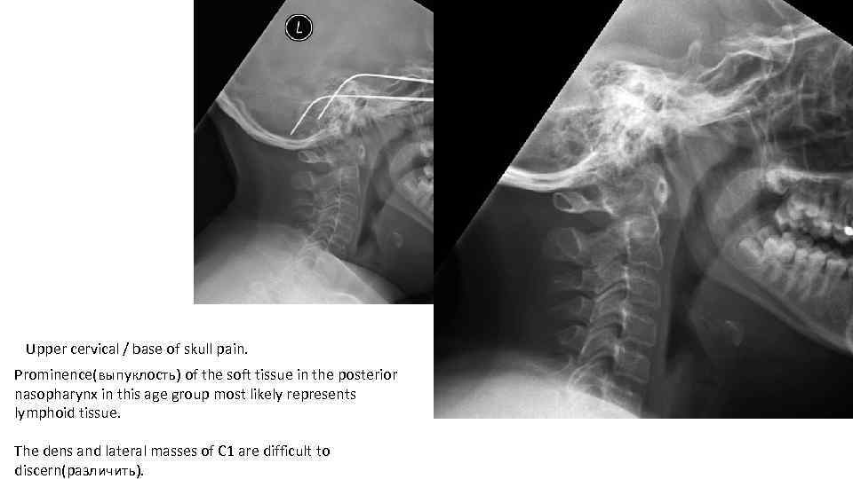 Upper cervical / base of skull pain. Prominence(выпуклость) of the soft tissue in the