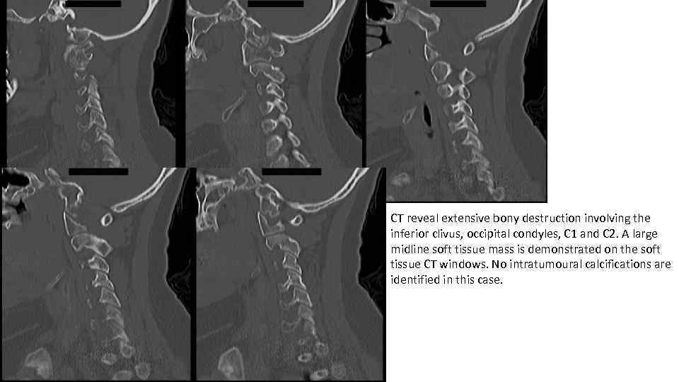 CT reveal extensive bony destruction involving the inferior clivus, occipital condyles, C 1 and