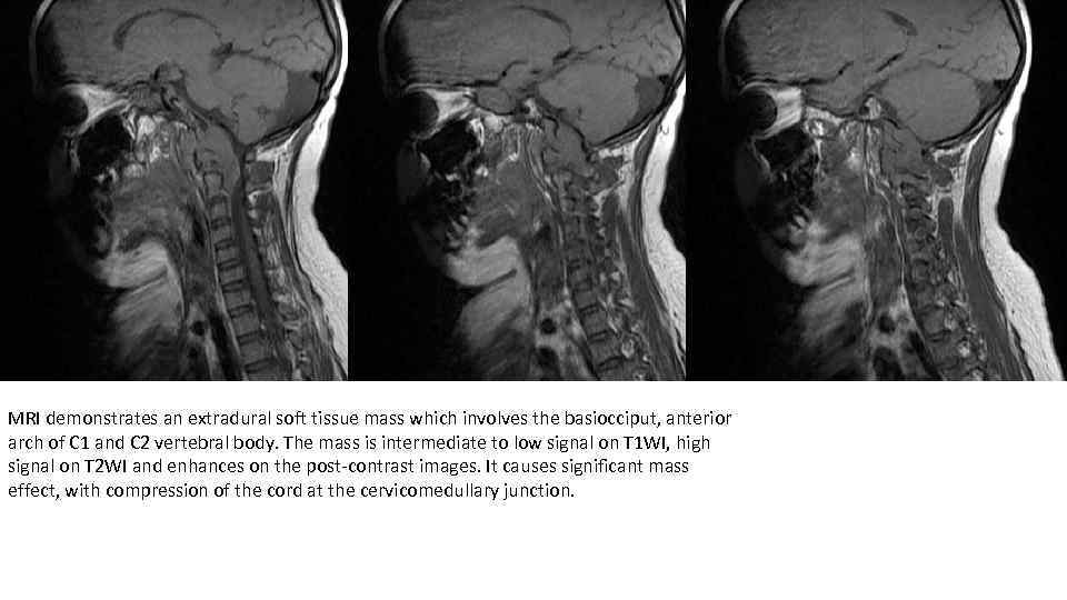 MRI demonstrates an extradural soft tissue mass which involves the basiocciput, anterior arch of