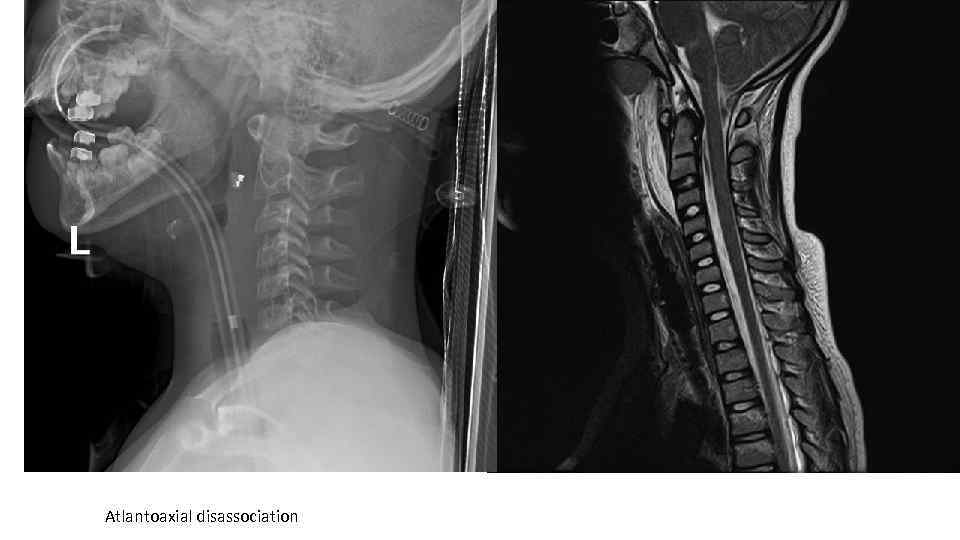 Atlantoaxial disassociation 