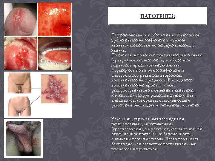 ПАТОГЕНЕЗ: Первичным местом обитания возбудителей урогенитальных инфекций у мужчин, является слизистая мочеиспускательного канала. Поднимаясь